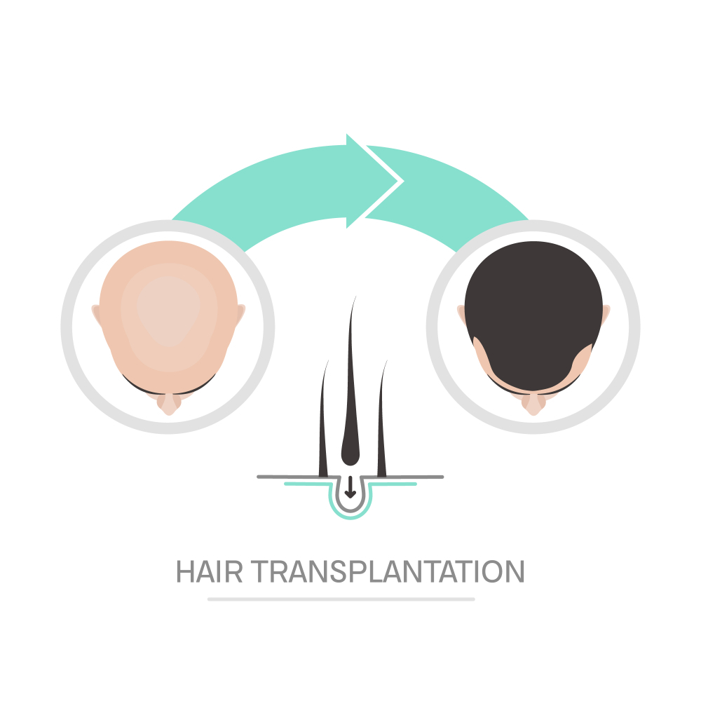 Top Benefits of Hair Transplantation