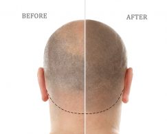 Before and after
